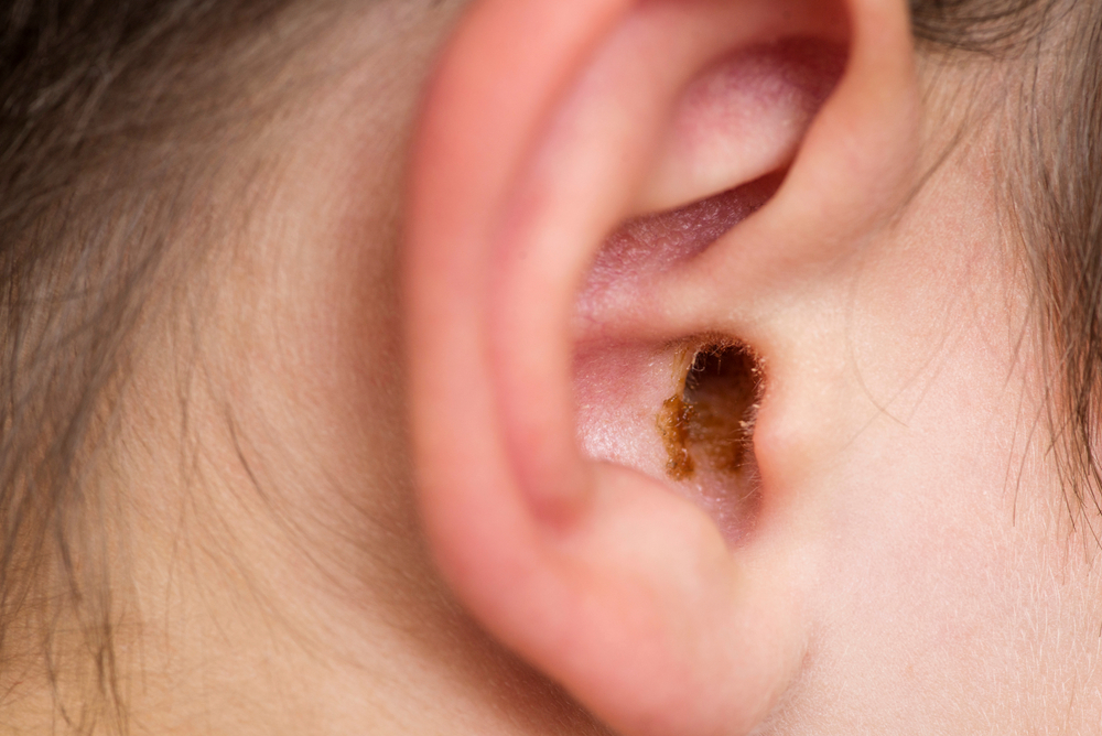 What Causes Earwax Buildup?